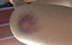 这些症状可能是白血病信号